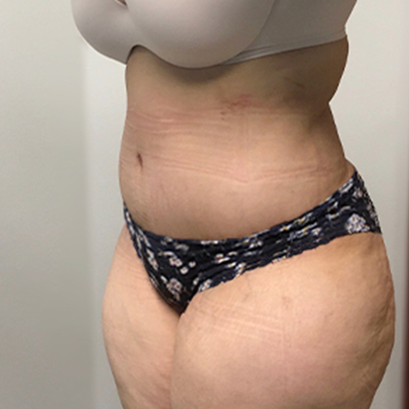 Abdominoplasty 03