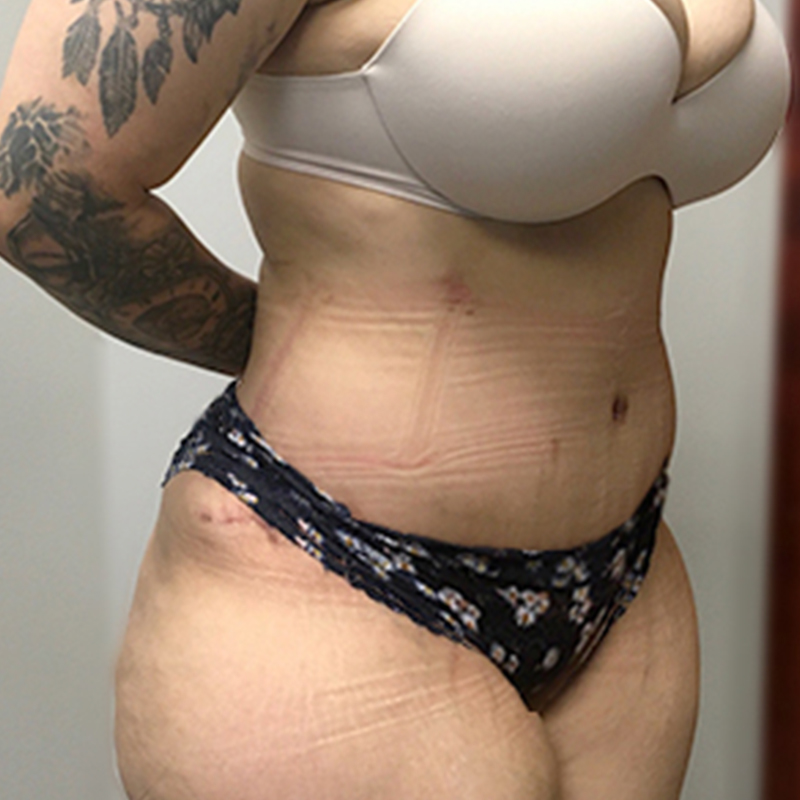 Abdominoplasty 07
