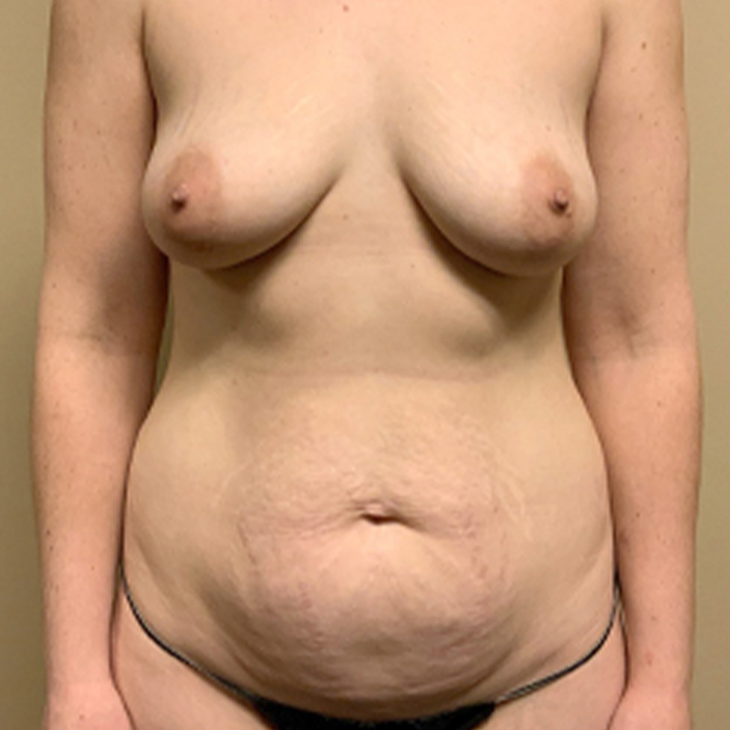Abdominoplasty 01