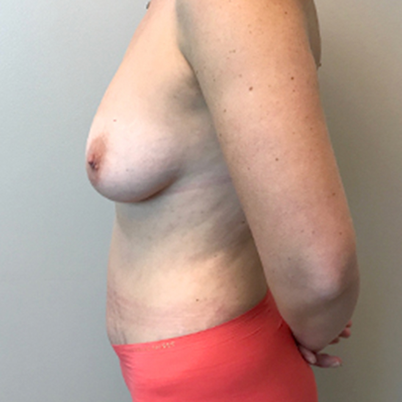 Abdominoplasty 05
