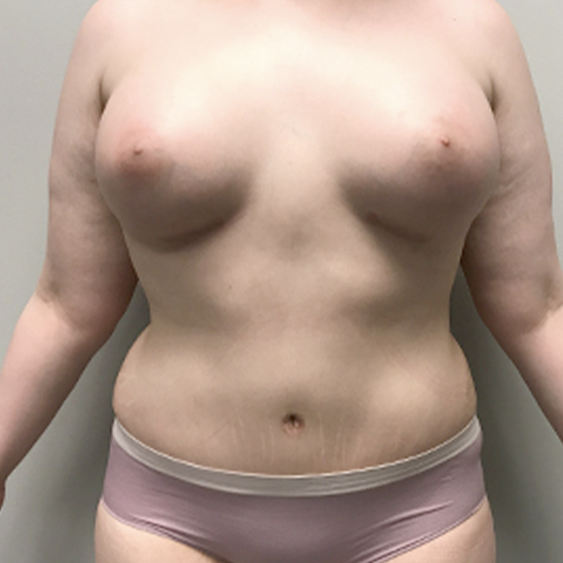 Abdominoplasty 52