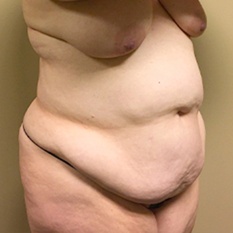Abdominoplasty 07