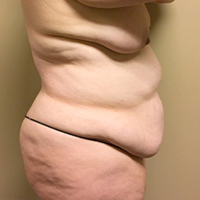 Abdominoplasty 09