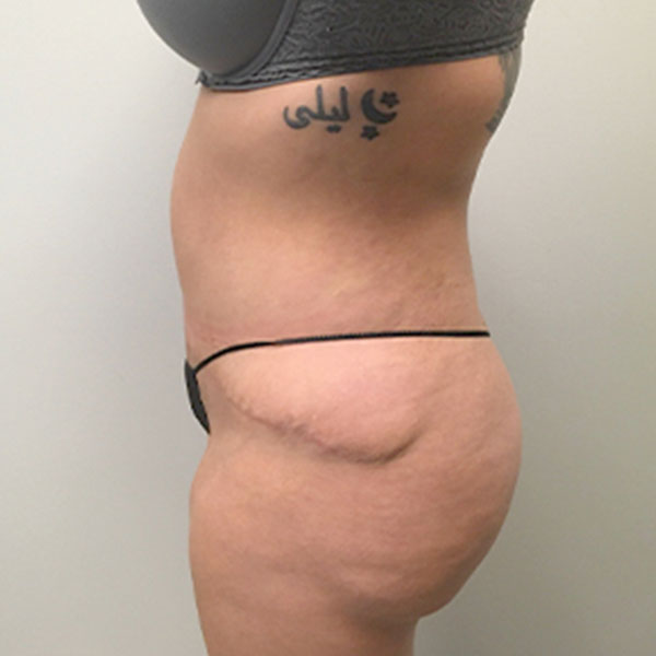 Abdominoplasty 05