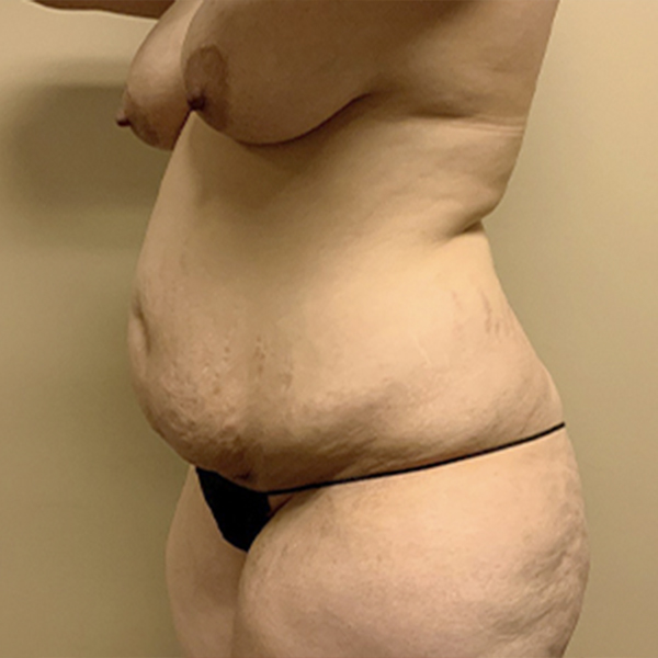 Abdominoplasty 03