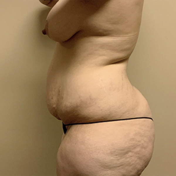 Abdominoplasty 05