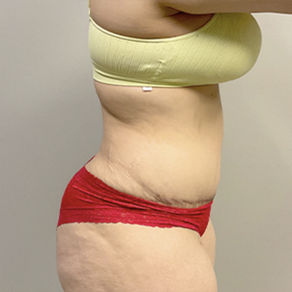 Abdominoplasty 09
