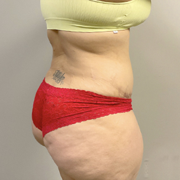 Abdominoplasty 11