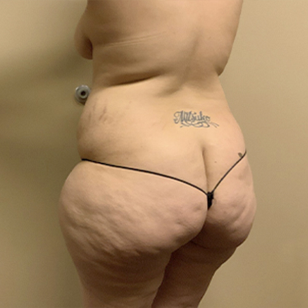 Abdominoplasty 13