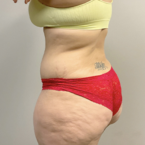Abdominoplasty 13