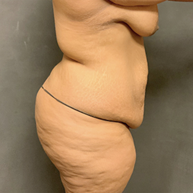 Abdominoplasty 09