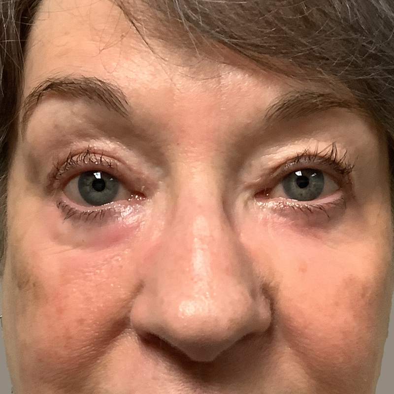 Blepharoplasty 01