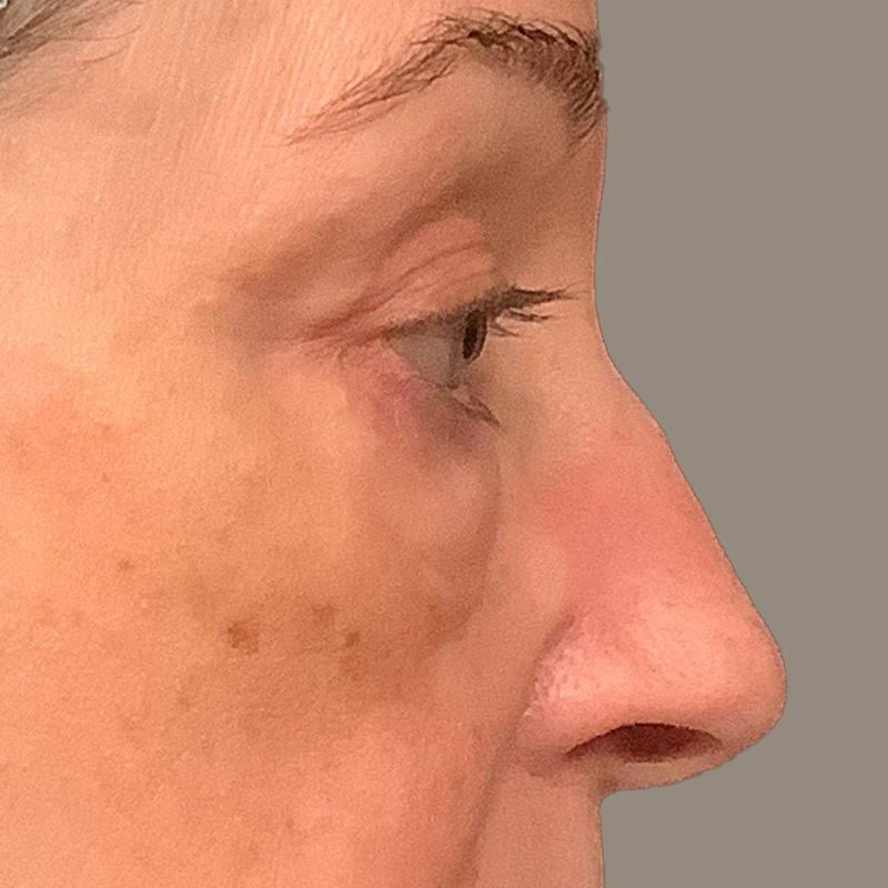 Blepharoplasty 03
