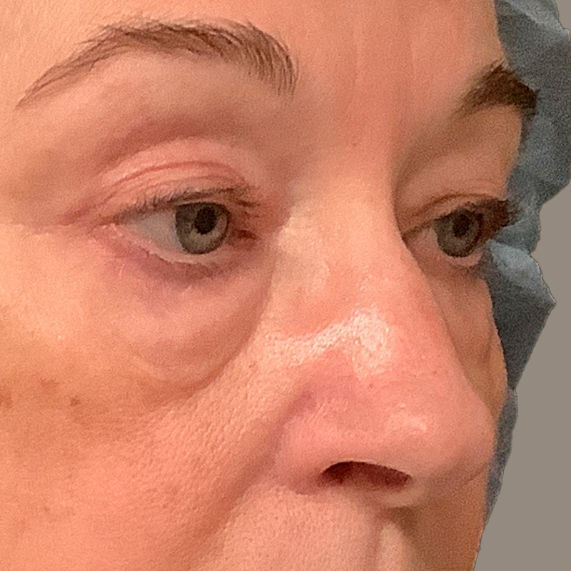 Blepharoplasty 07