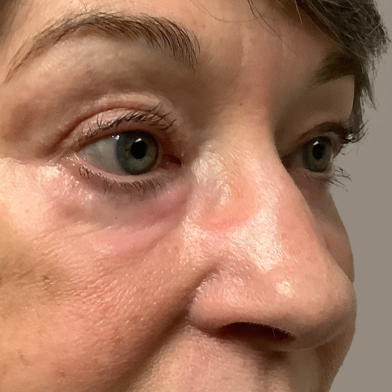 Blepharoplasty 07