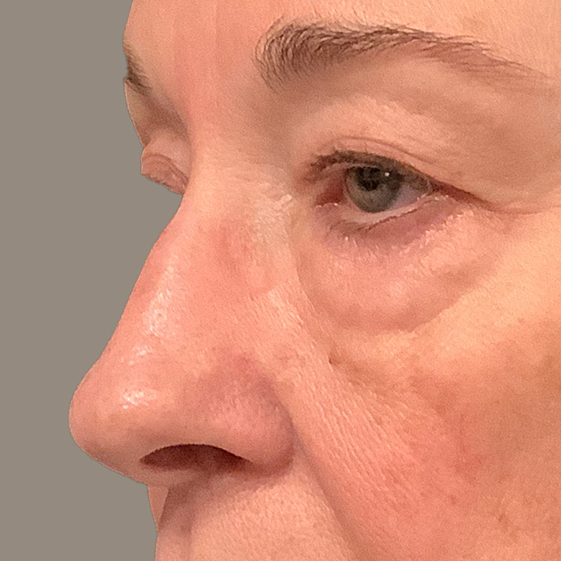 Blepharoplasty 09