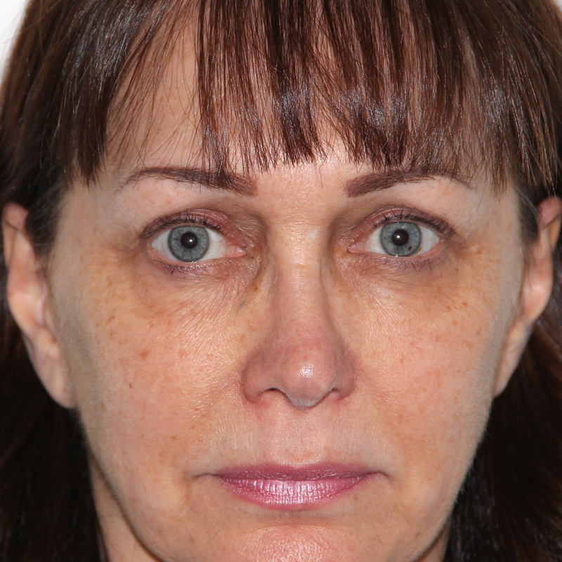 Blepharoplasty 01