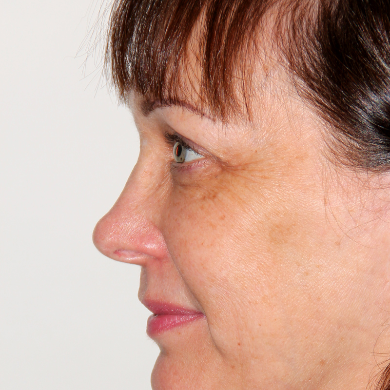 Blepharoplasty 03