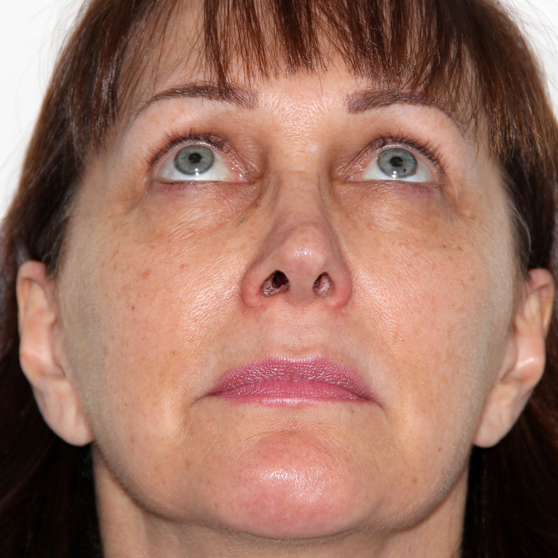 Blepharoplasty 05