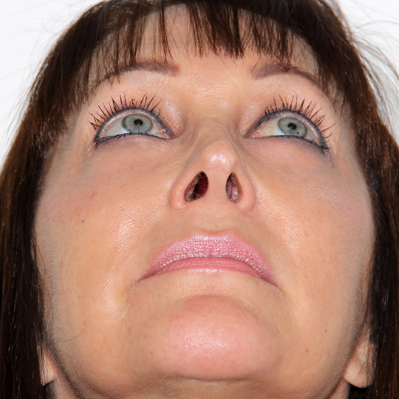 Blepharoplasty 05