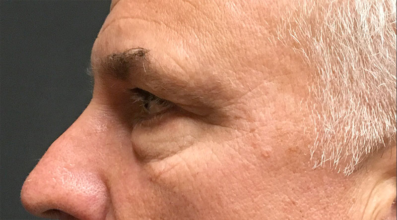 Blepharoplasty 03