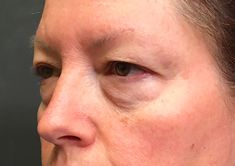 Blepharoplasty 03