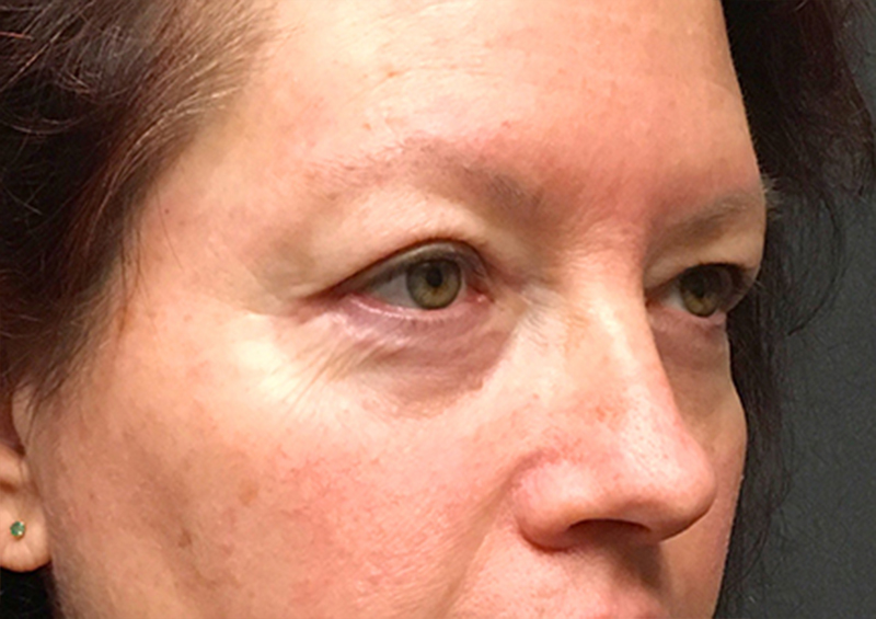 Blepharoplasty 07