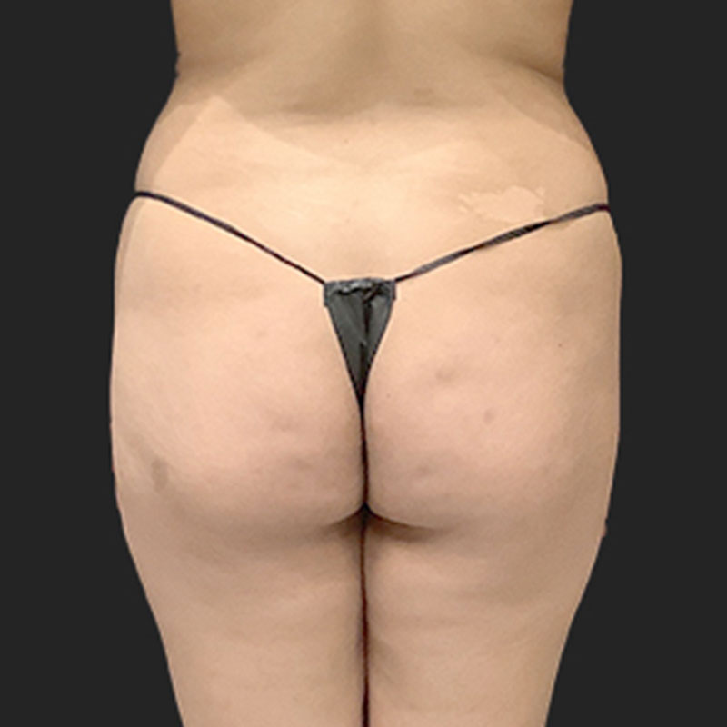 Brazilian Butt Lift 01