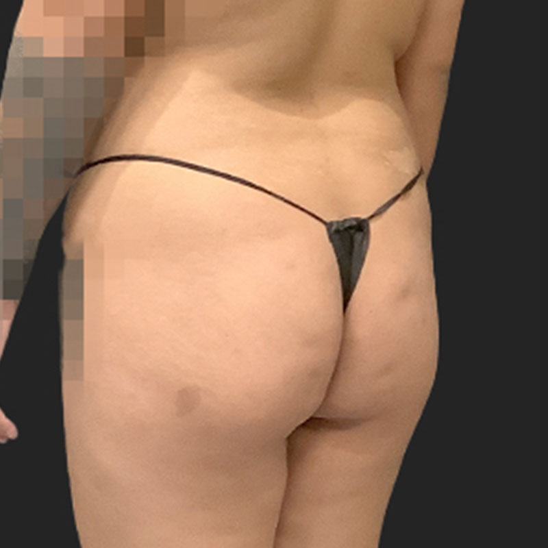 Brazilian Butt Lift 03