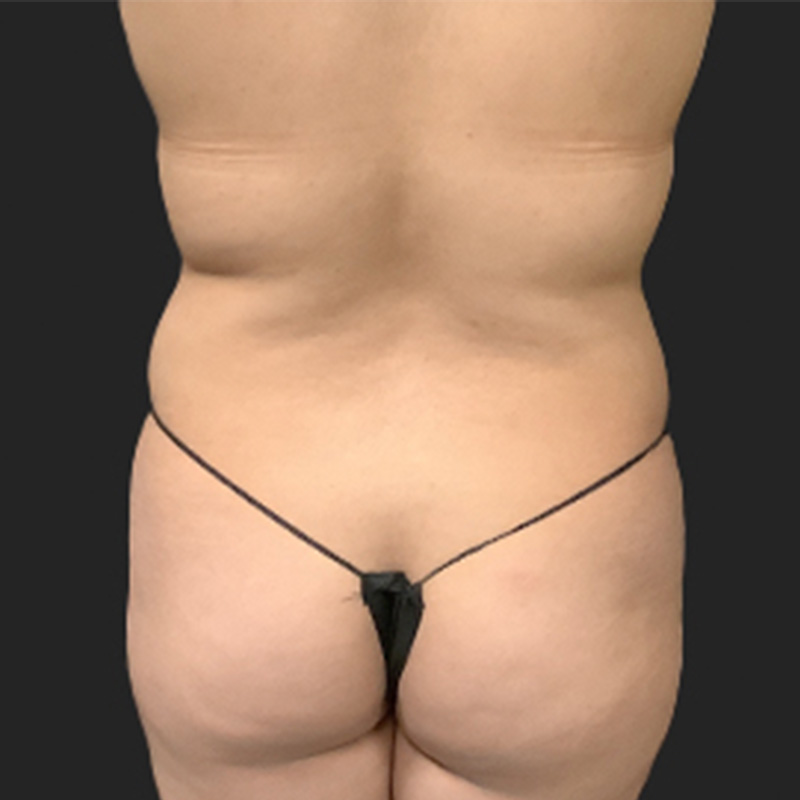 Brazilian Butt Lift 01