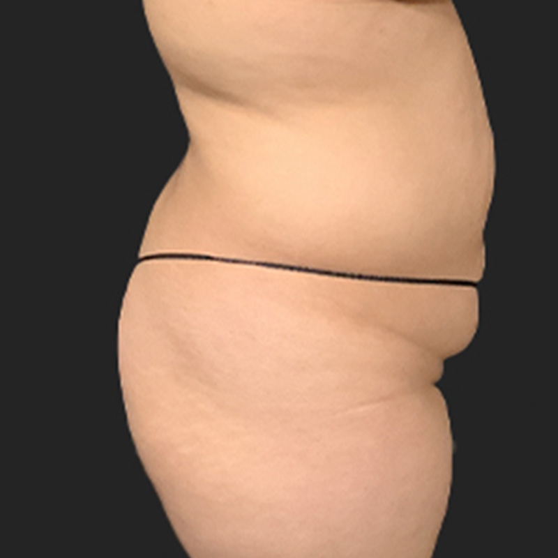 Brazilian Butt Lift 03