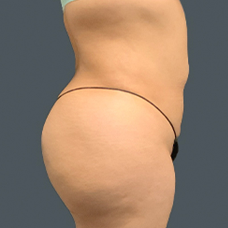 Brazilian Butt Lift 03