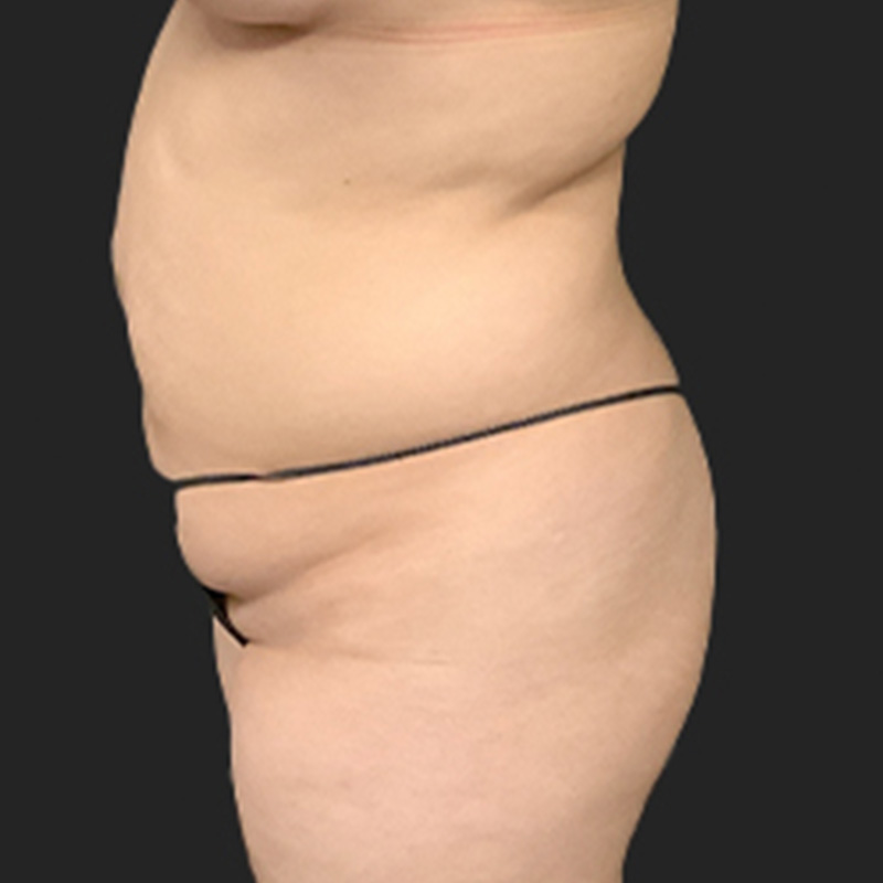 Brazilian Butt Lift 05