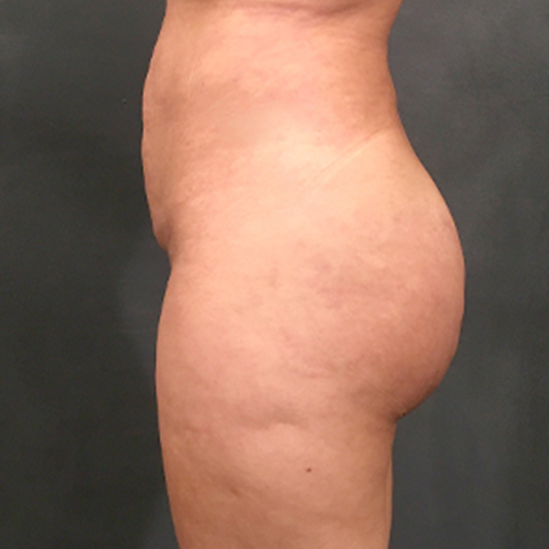 Brazilian Butt Lift 07