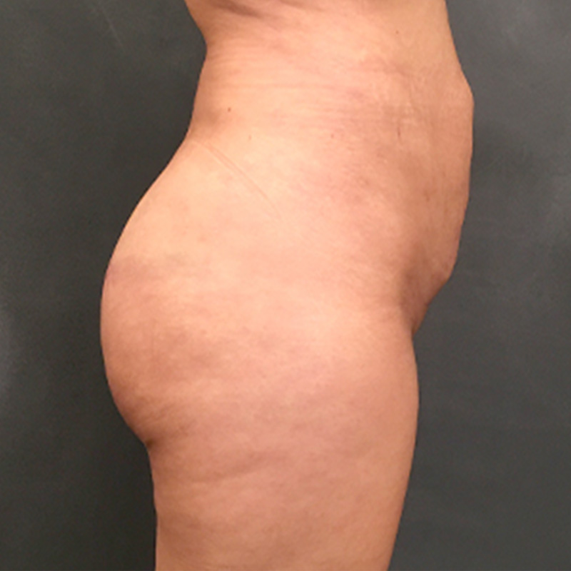 Brazilian Butt Lift 03