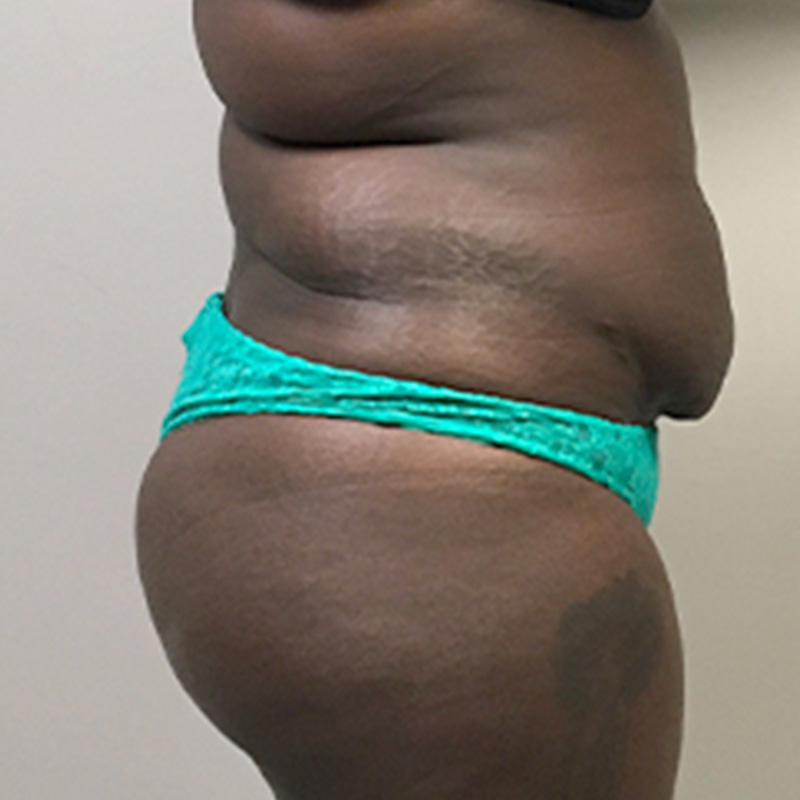 Brazilian Butt Lift 05