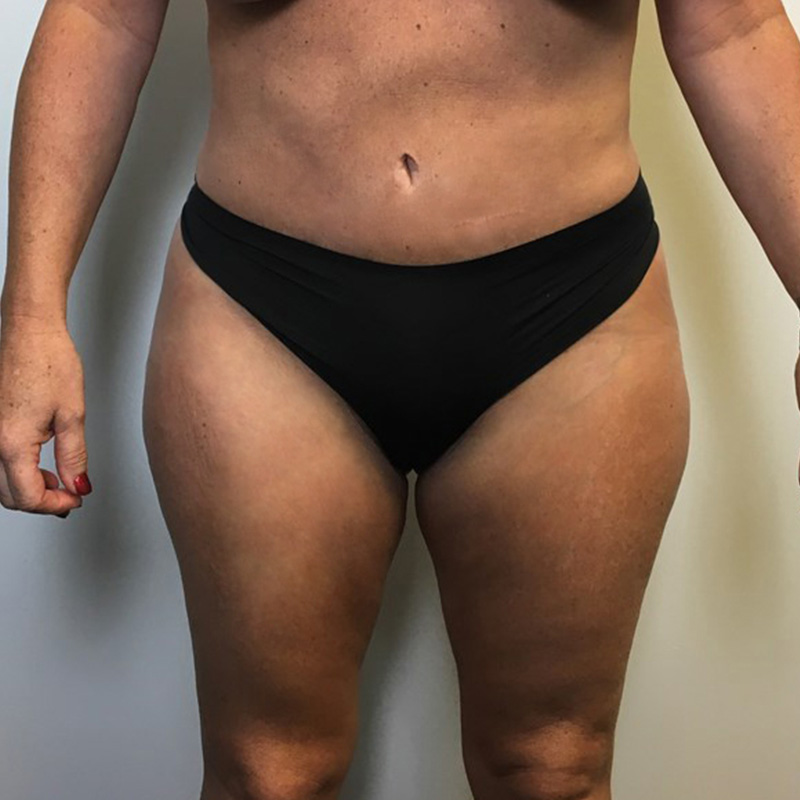 Brazilian Butt Lift 09