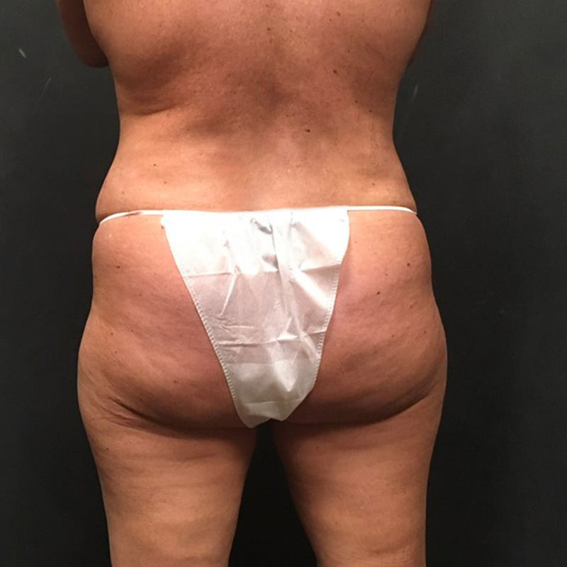 Brazilian Butt Lift 03