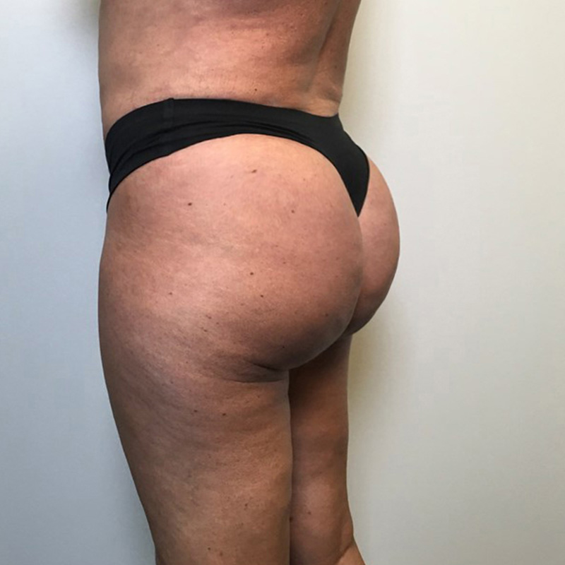 Brazilian Butt Lift 05