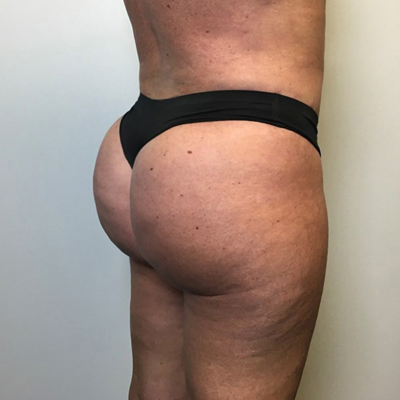 Brazilian Butt Lift 07