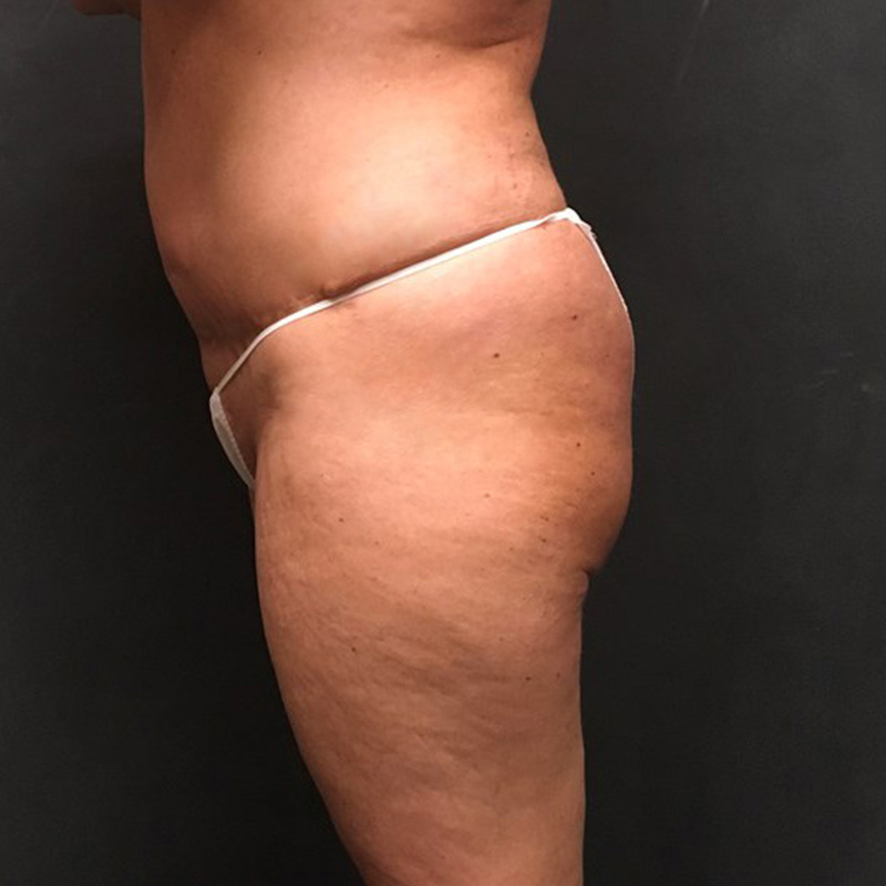 Brazilian Butt Lift 09