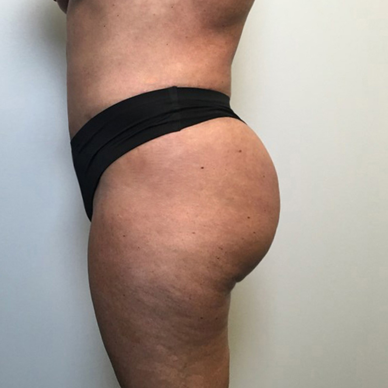 Brazilian Butt Lift 09