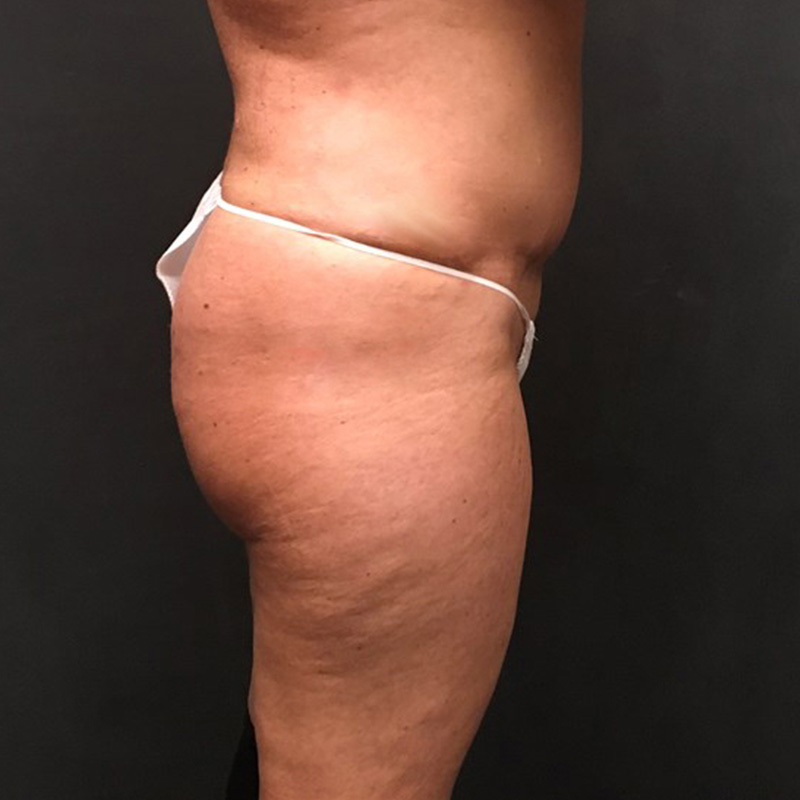 Brazilian Butt Lift 11