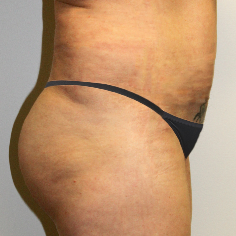 Brazilian Butt Lift 03