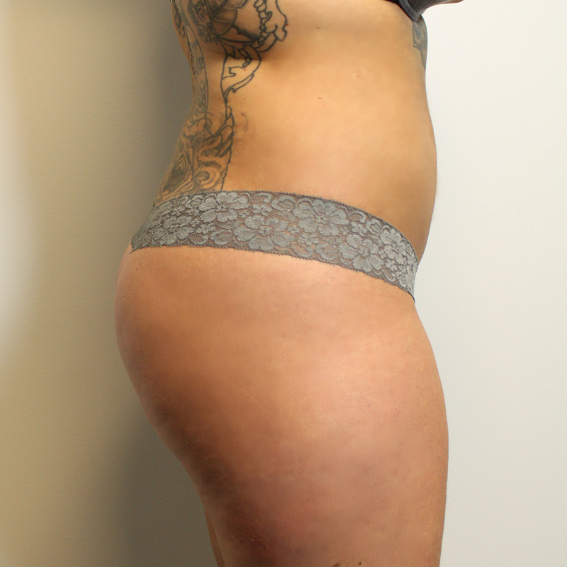 Brazilian Butt Lift 03