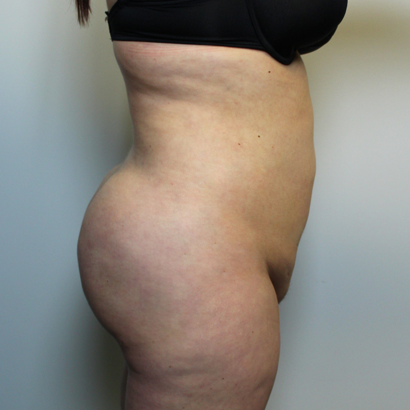 Brazilian Butt Lift 07