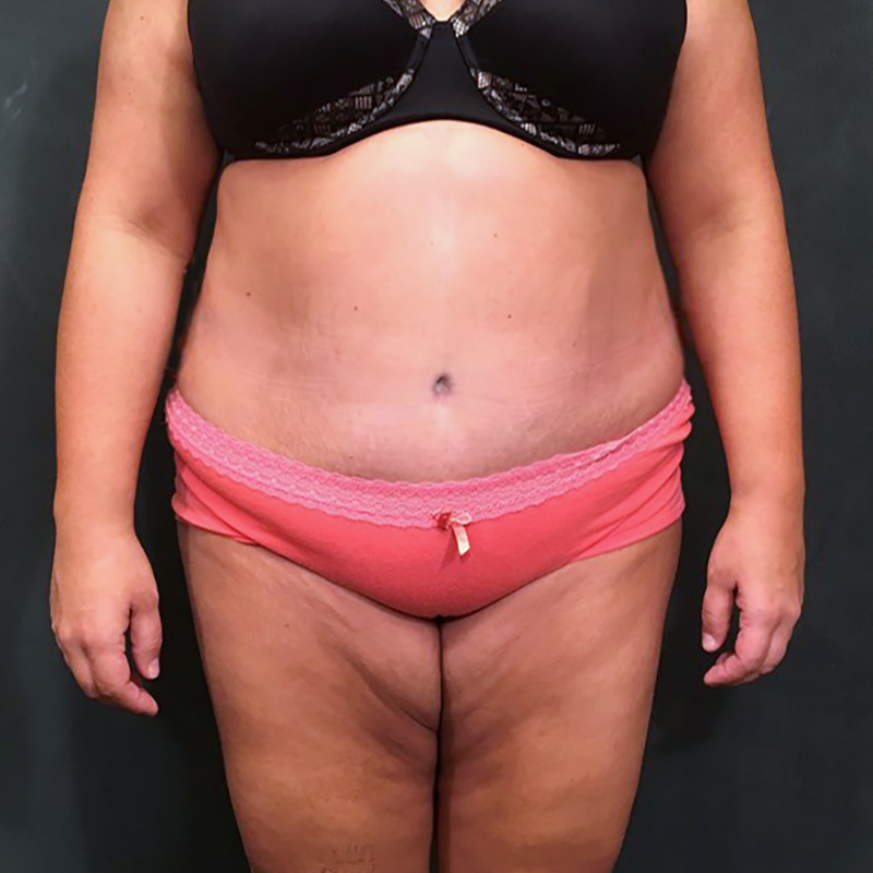 Brazilian Butt Lift 20