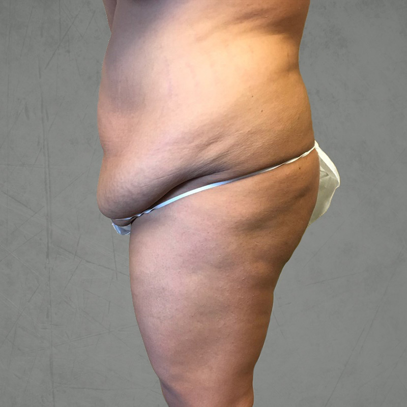 Brazilian Butt Lift 07