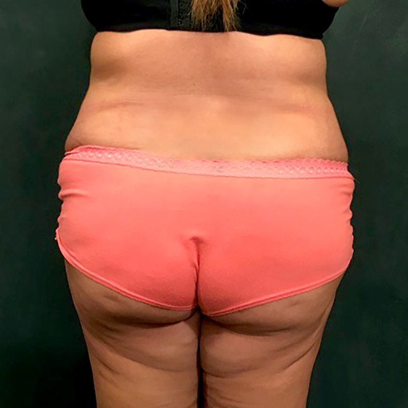 Brazilian Butt Lift 11