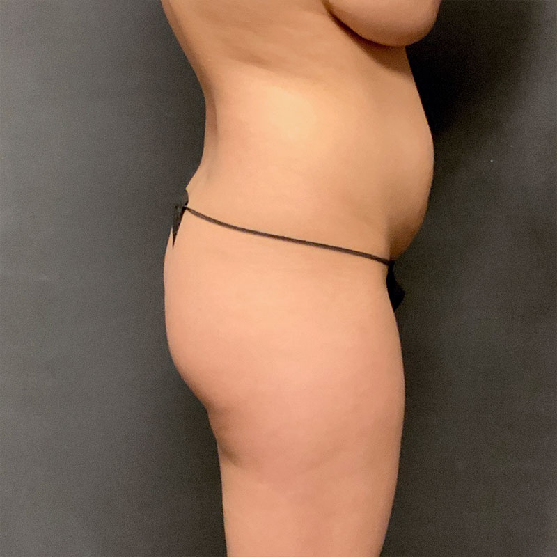 Brazilian Butt Lift 03